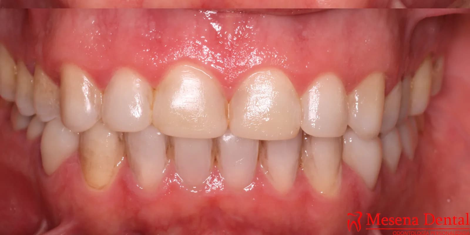 Rehabilitación de dientes desgastados: comparación de la sonrisa antes y después — después