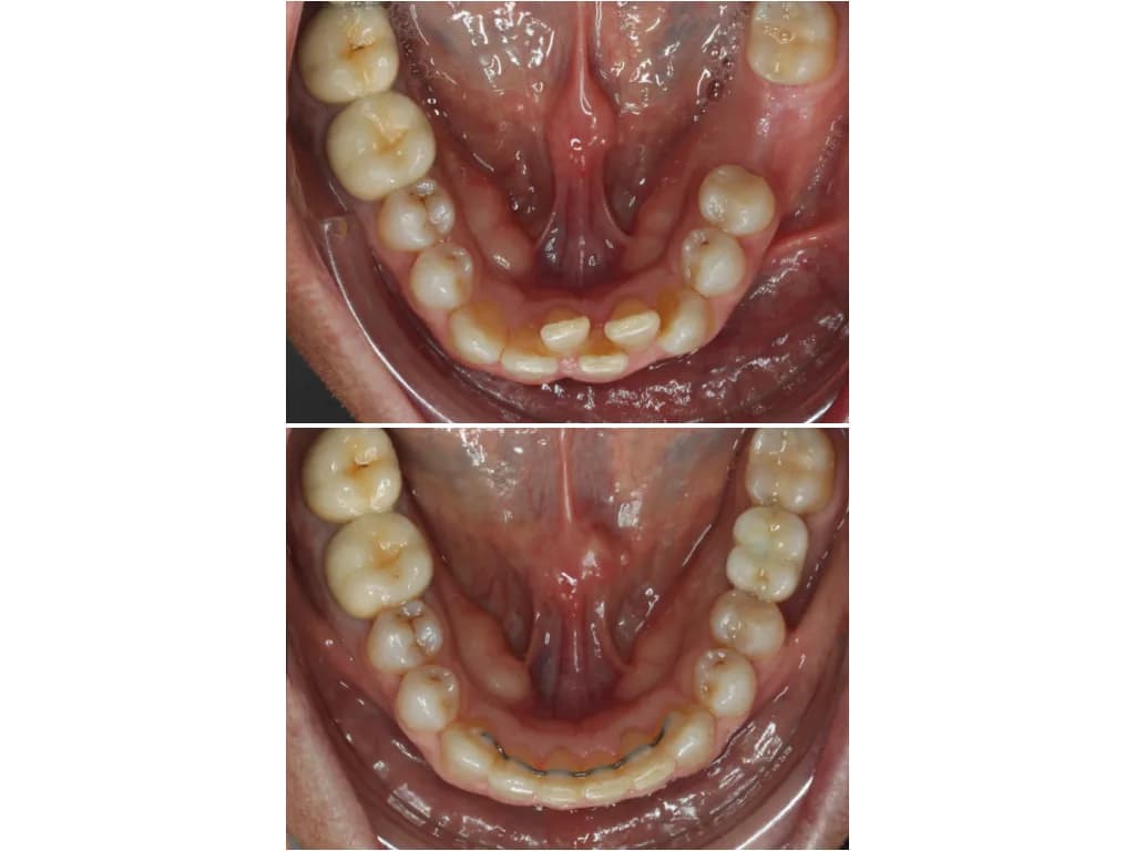 ALINEAMIENTO Y REPOSICION DENTAL
