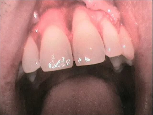 Periodoncia VS Implantes