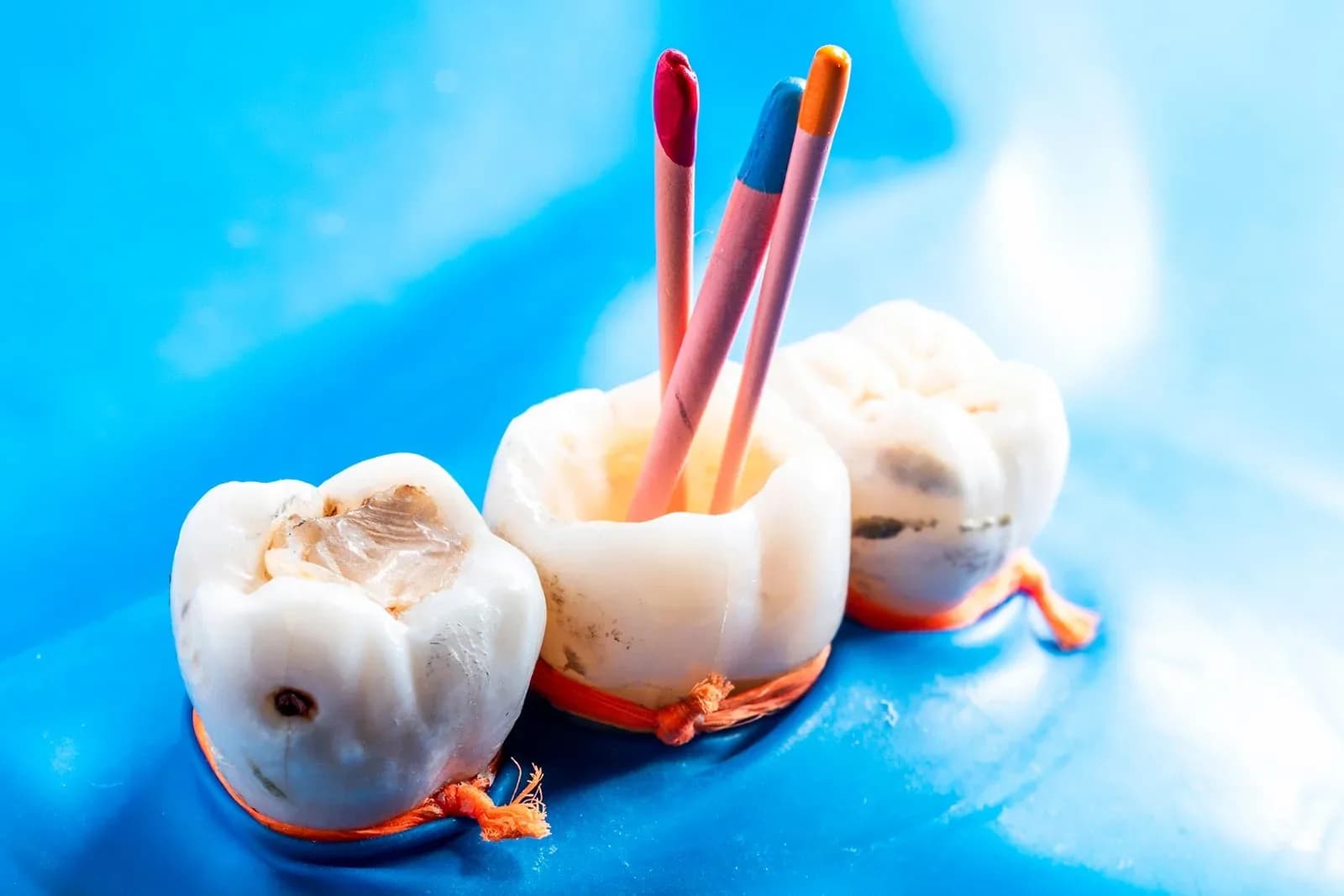 Piezas dentales con limas de endodoncia