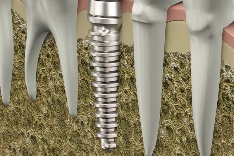 Implante dental integrado en el hueso entre dos dientes