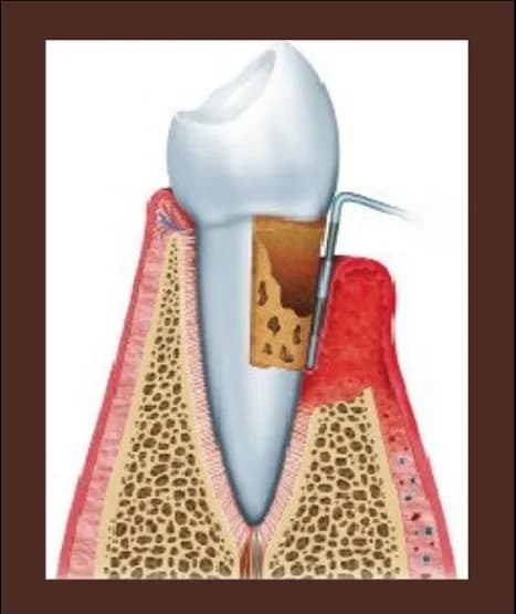 Ilustración de una encía con periodontitis avanzada
